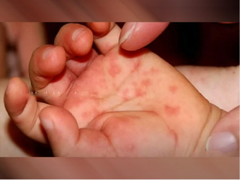 What Is Tomato Flu Infecting Young Children In Kerala? Check Symptoms, Treatment, Precautions